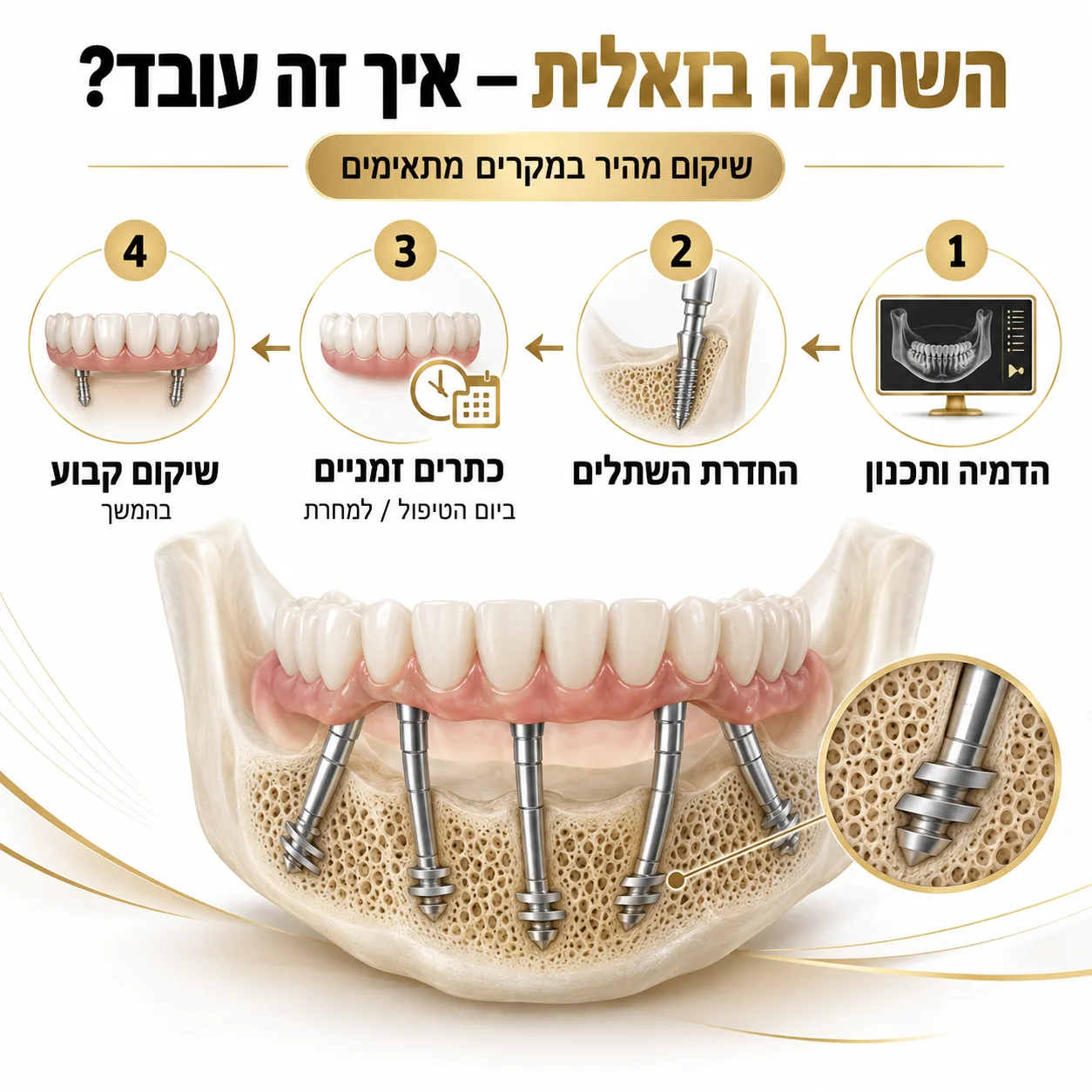 שתלים בזאלים | אינפוגרפיקה