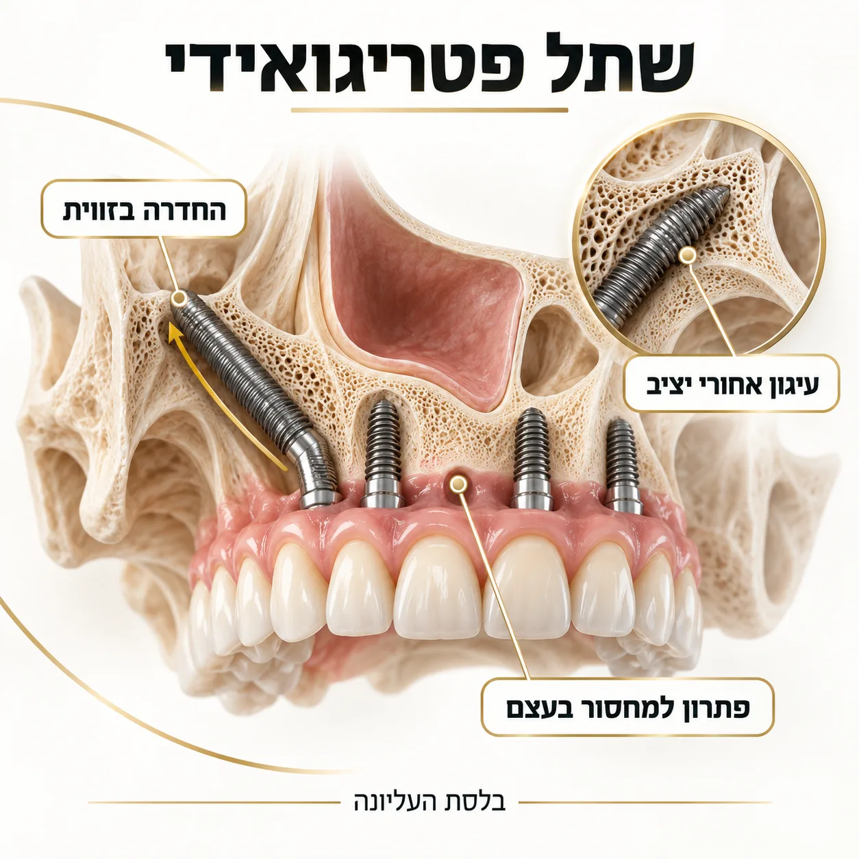 שתלים פטרוגואידים | אינפוגרפיקה